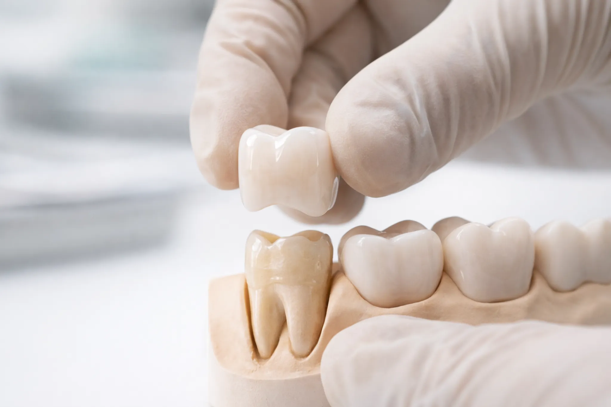 Crowns Bridges Dentures